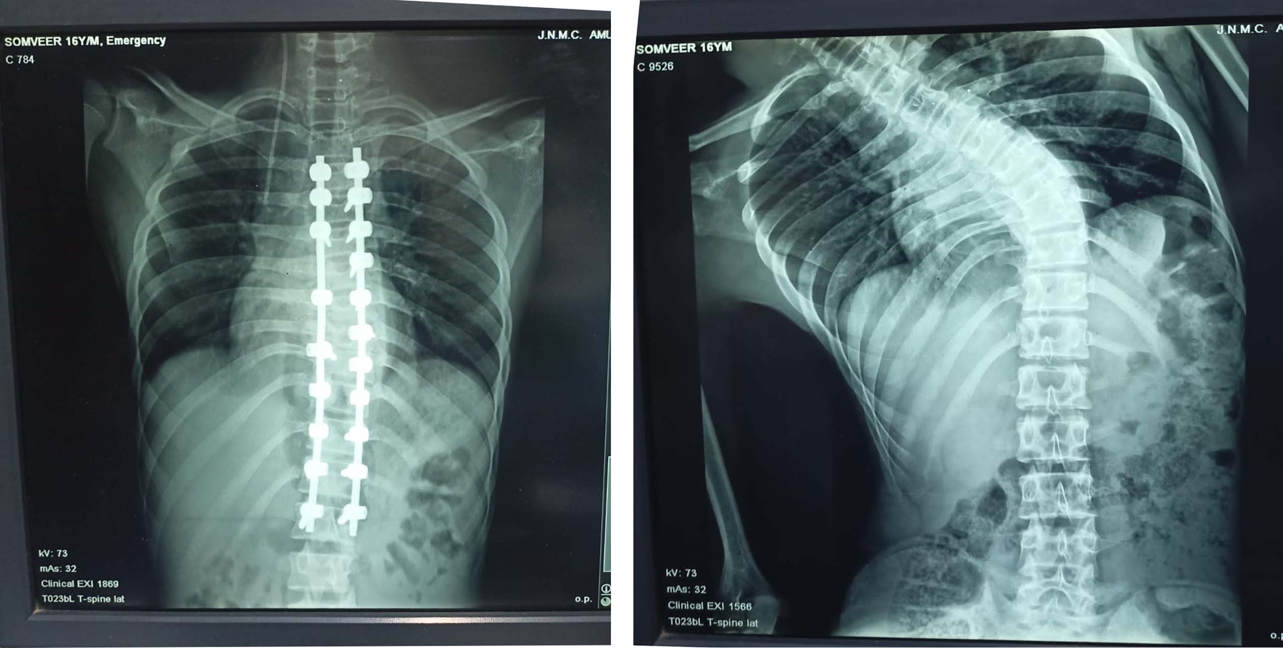 You are currently viewing JNMC surgeons successfully make spinal correction procedure