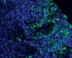 Read more about the article UCSF Researchers Re-examine How Cancer Cells Evade Targeted Therapy